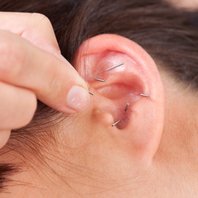 Öron akupunktur med nålar och med kulplåster
